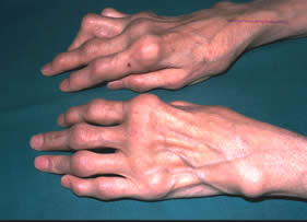 Reumatski artritis