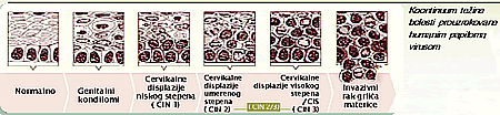 Koontinuum te�ine bolesti prouzrokovane humanim papiloma virusom